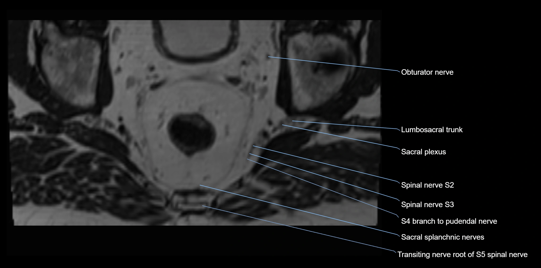 MR lumbosacral plexus axial cross sectional anatomy 3T  radiology  image-img-1008001-00108.webp